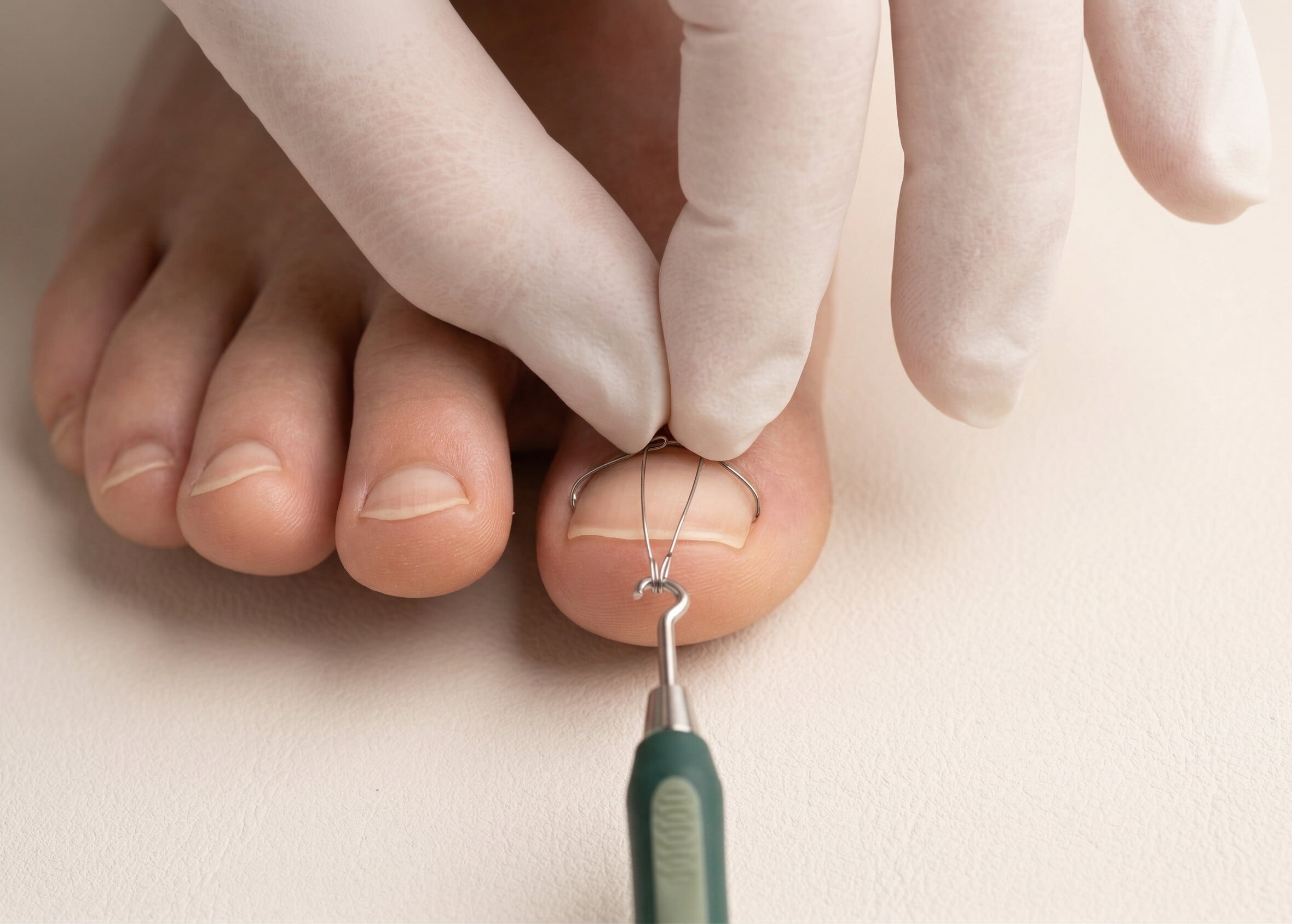 3TO-Spange- – Individuelle Behandlung bei Rollnägeln