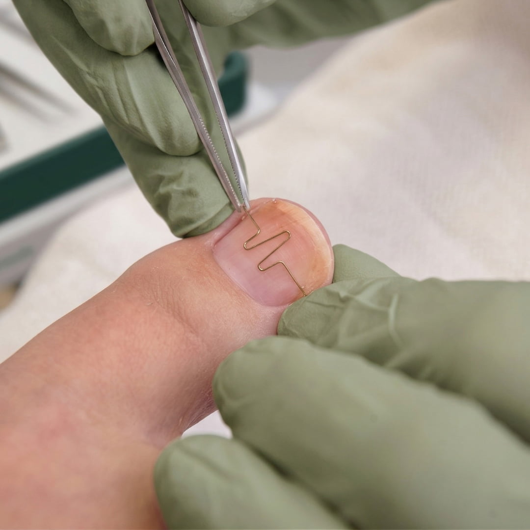 Professionelle Spangentherapie in Beelitz – Sanfte Nagelkorrektur im Podologikum Heilstätten